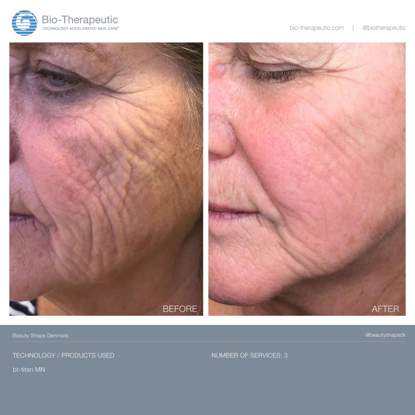 bt-titan® MN model AE +FREE AquaFuse Tech Peel 4oz + Nano Tip Cartridge 20 pack